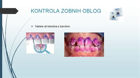 zobna dlesen dojenčka