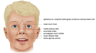 Infografika, ki prikazuje značilne obrazne poteze pri FAS.