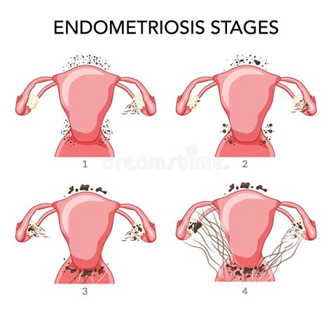 oblike endometrioze