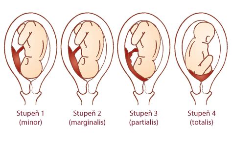 Diagram položaja posteljice v maternici - normalni položaj in placenta previa