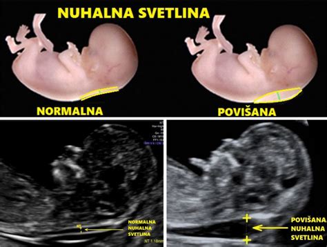 Ultrazvočni prikaz nuhalne svetline nerojenega otroka