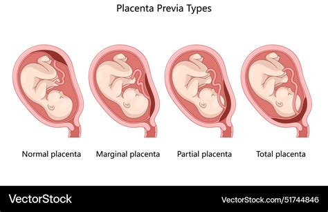 Diagram predležeče posteljice (placenta praevia)