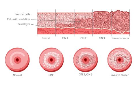 Diagram, ki prikazuje povezavo med HPV, CIN in rakom na materničnem vratu