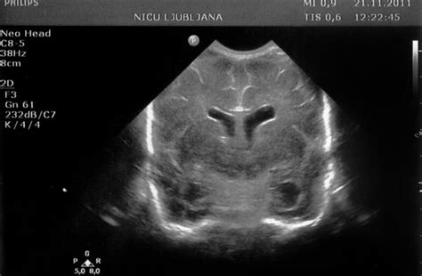 Ultrazvočna slika povečane maternice psičke s piometro