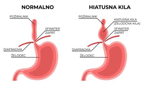 Diagram, ki prikazuje želodec in požiralnik z oznako sfinktra