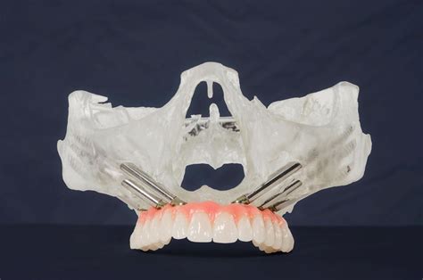 Diagram človeške čeljusti z označenimi zobmi in nebom