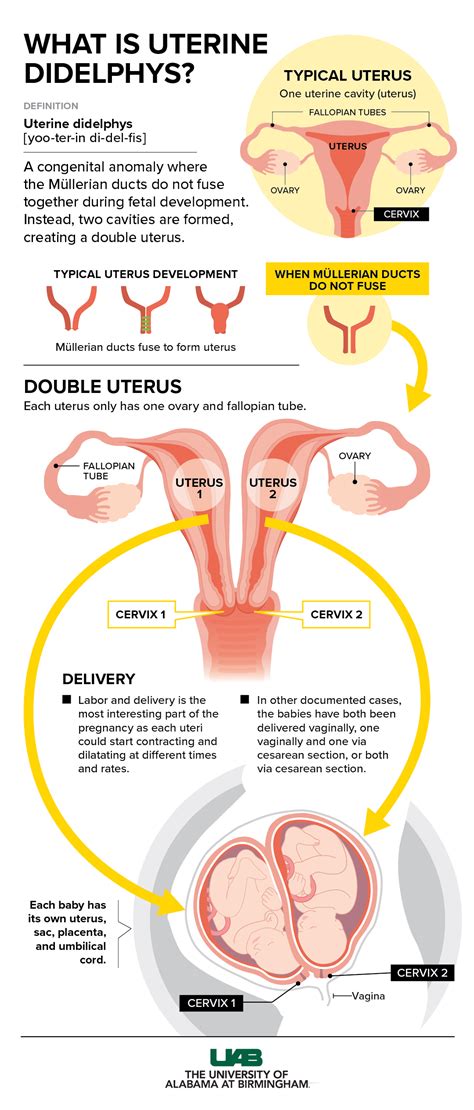 Diagram dvojne maternice (uterus didelphys)