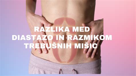 Diagram, ki prikazuje razmik prečnih trebušnih mišic (diastazo)