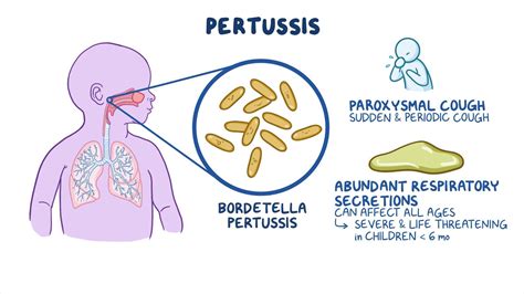 Infografika, ki prikazuje prenos bakterije Bordetella pertussis s kapljicami