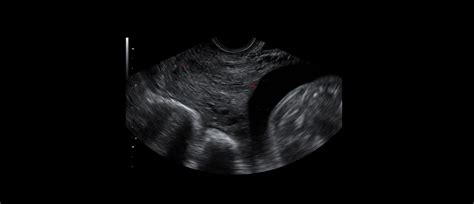 Ultrazvok materničnega vratu