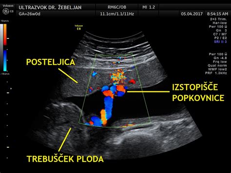 Ultrazvočni prikaz prečnega preseka glavice ploda z označenimi meritvami