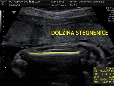 Ultrazvočni prikaz stegnenice ploda z označenimi meritvami