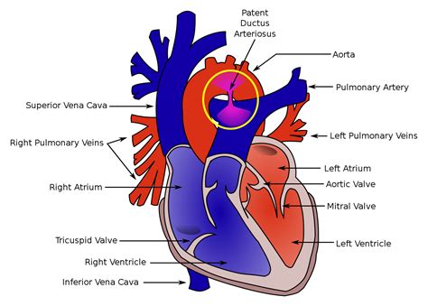 Diagram prikazuje prezgodnje zapiranje ductus arteriosus