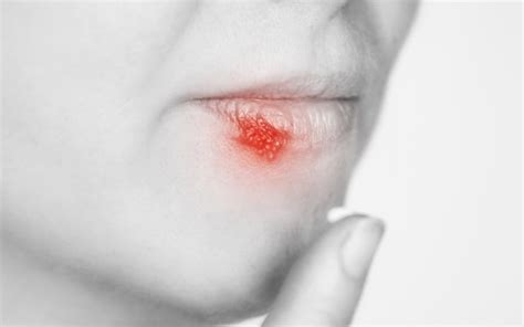 Herpes na ustnicah pri otroku