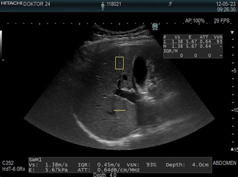 Ultrazvok jajčnikov s folikli