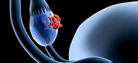 Simptomi ciste na jajčnikih