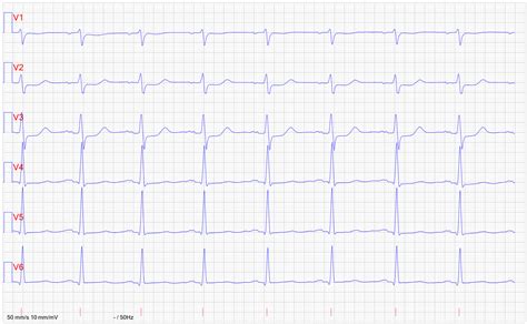 Prikaz EKG krivulje