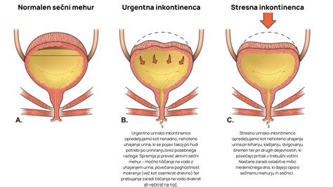 Diagram, ki prikazuje mehanizem stresne urinske inkontinence