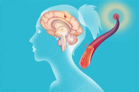 Ilustracija, ki prikazuje razliko med plagiocefalijo in brahicefalijo.