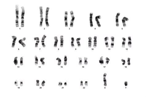Diagram človeškega kariotipa z označenim 15. kromosomom