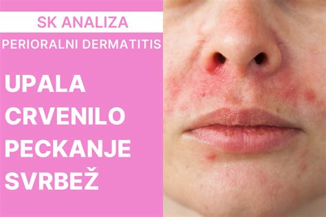 perioralni dermatitis pri otroku