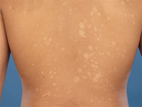 Lise pityriasis versicolor na hrbtu
