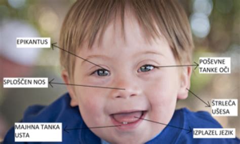 Grafikon, ki prikazuje povečanje tveganja za Downov sindrom z rastjo debeline nuhalne svetline