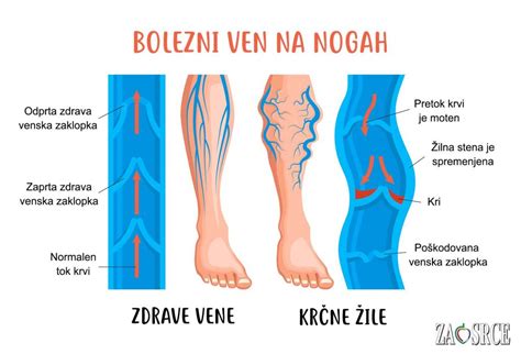 Ilustracija povečanega pritiska na žile v nogah med nosečnostjo