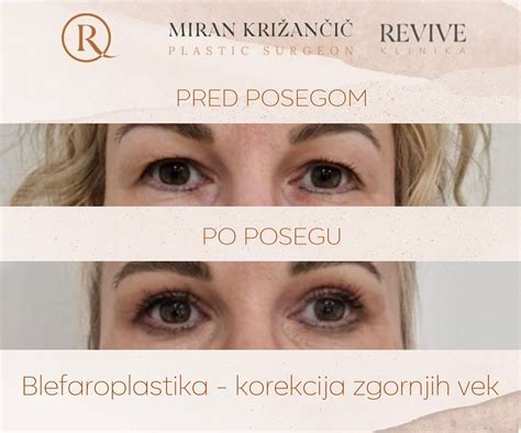 Primerjava prsi pred in po kombiniranem posegu dviga in povečanja