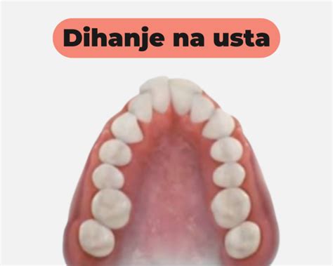 Grafični prikaz posledic dihanja skozi usta na razvoj obraza otroka