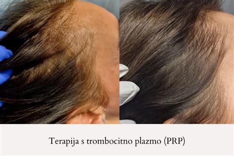 Graf prikazuje rast las po PRP terapiji