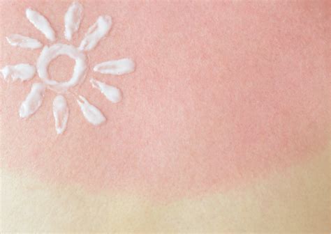 Diagram ultravijoličnega sevanja, ki prodira v kožo