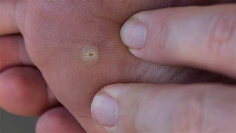 Ilustracija merjenja premera bradavice z ravnilom