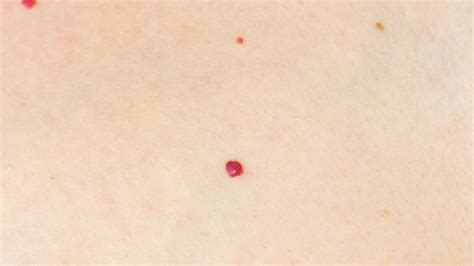 Različne vrste znamenj pri dojenčkih: pigmentno znamenje, hemangiom, ognjeno znamenje, mongolska lisa