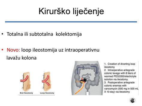 Shema, ki prikazuje različne vrste histerektomije (totalna, subtotalna, radikalna)