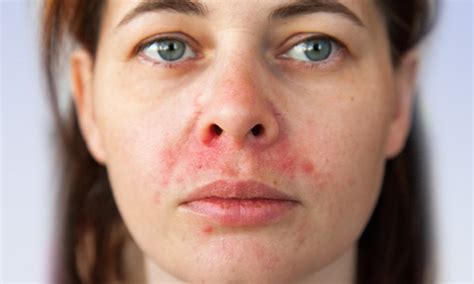 Mama neguje dojenčka z izpuščajem okoli ust