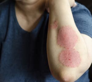 Primerjava simptomov seboroičnega in atopijskega dermatitisa