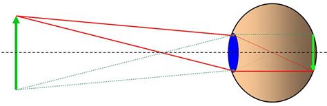 Diagram, ki prikazuje strukturo človeškega očesa in kako laser deluje na roženico