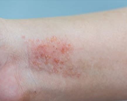 Ilustracija srbečih izpuščajev na koži