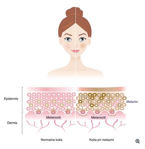 Primer melazme na obrazu nosečnice