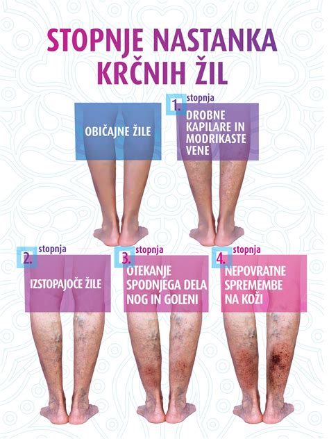 Infografika prikazuje učinke nosečnosti na cirkulacijo in pojav krčnih žil
