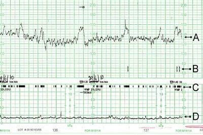 Kardiotokografija (CTG)