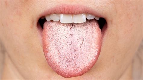 prikaz anatomije dojenčkovega jezika s poudarkom na frenulumu