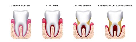 Diagram vnetja dlesni