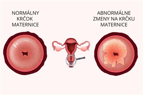 diagram procesa krčenja maternice po porodu