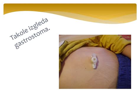 Otrok z gastrostoma cevko