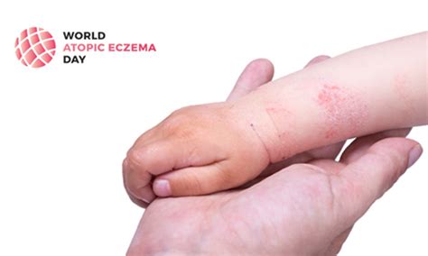 Simbolična upodobitev atopičnega dermatitisa