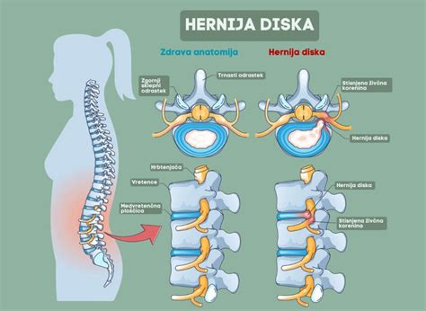Diagram, ki prikazuje hernijo diska v vratni hrbtenici