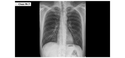 Slika RTG posnetka medenice z vgrajeno ploščico