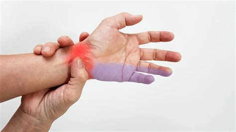 Diagram prikazuje sindrom zapestnega prehoda in sindrom kubitalnega kanala, z označenimi živci in predeli, kjer prihaja do utesnitve.